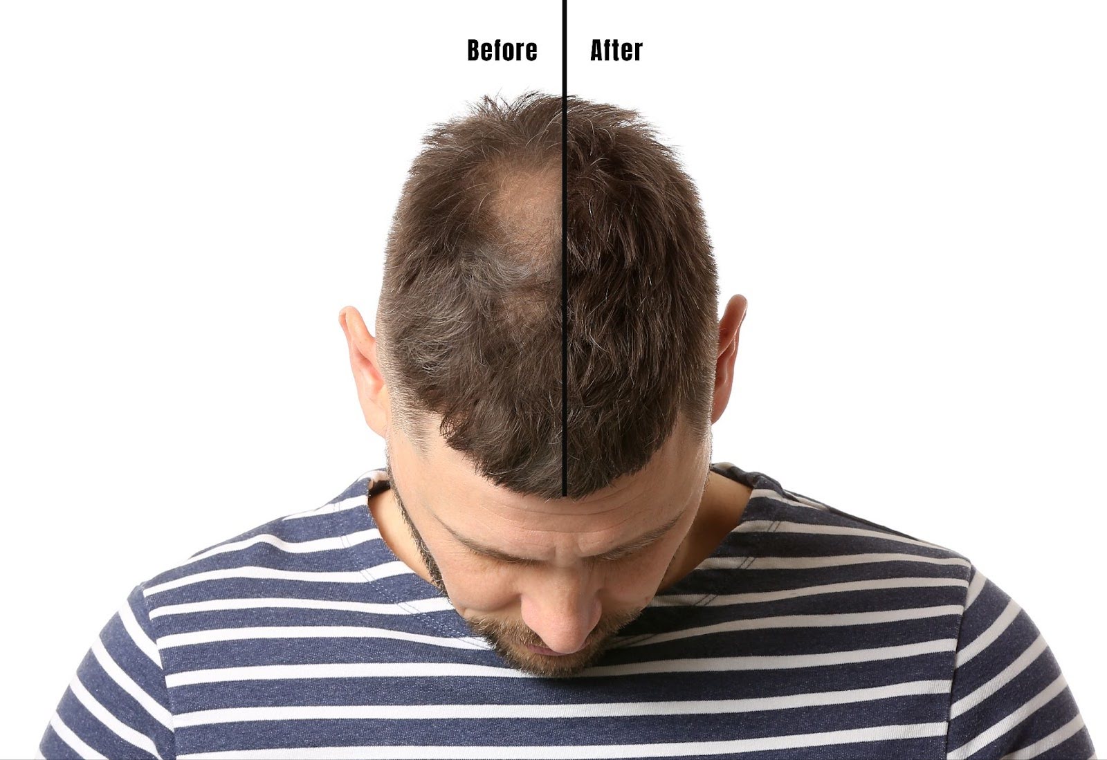 effectiveness of finasteride