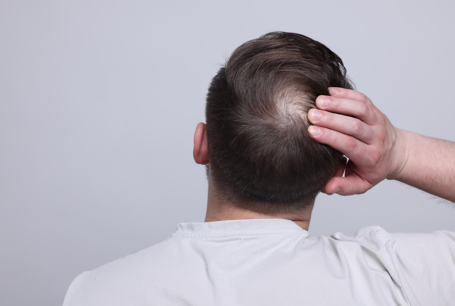 alternative finasteride