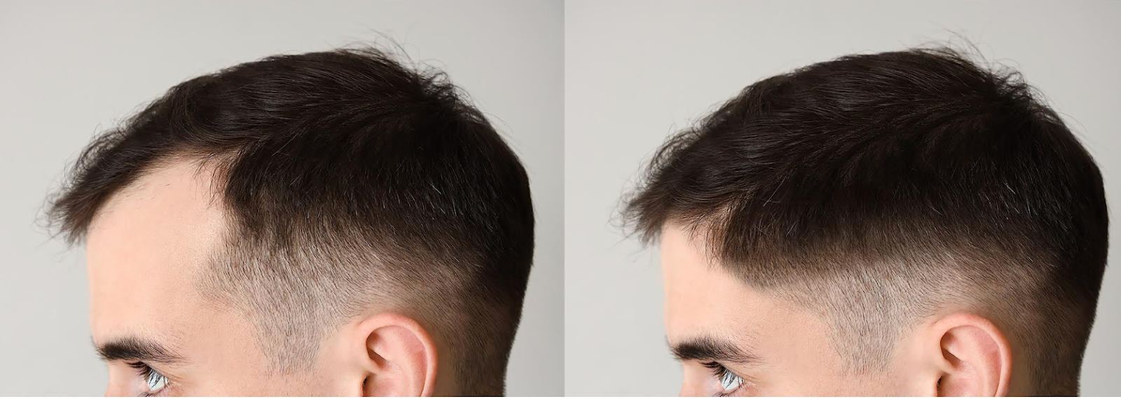 natural finasteride