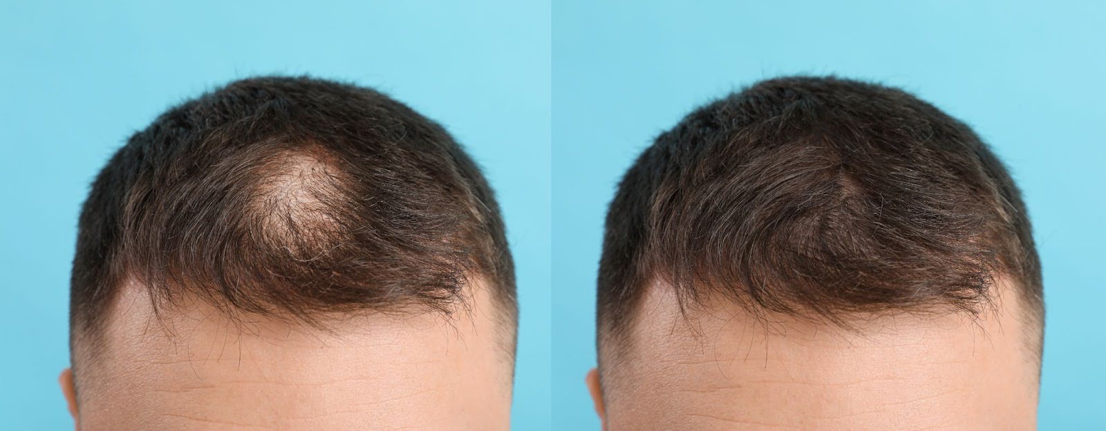 topical finasteride results